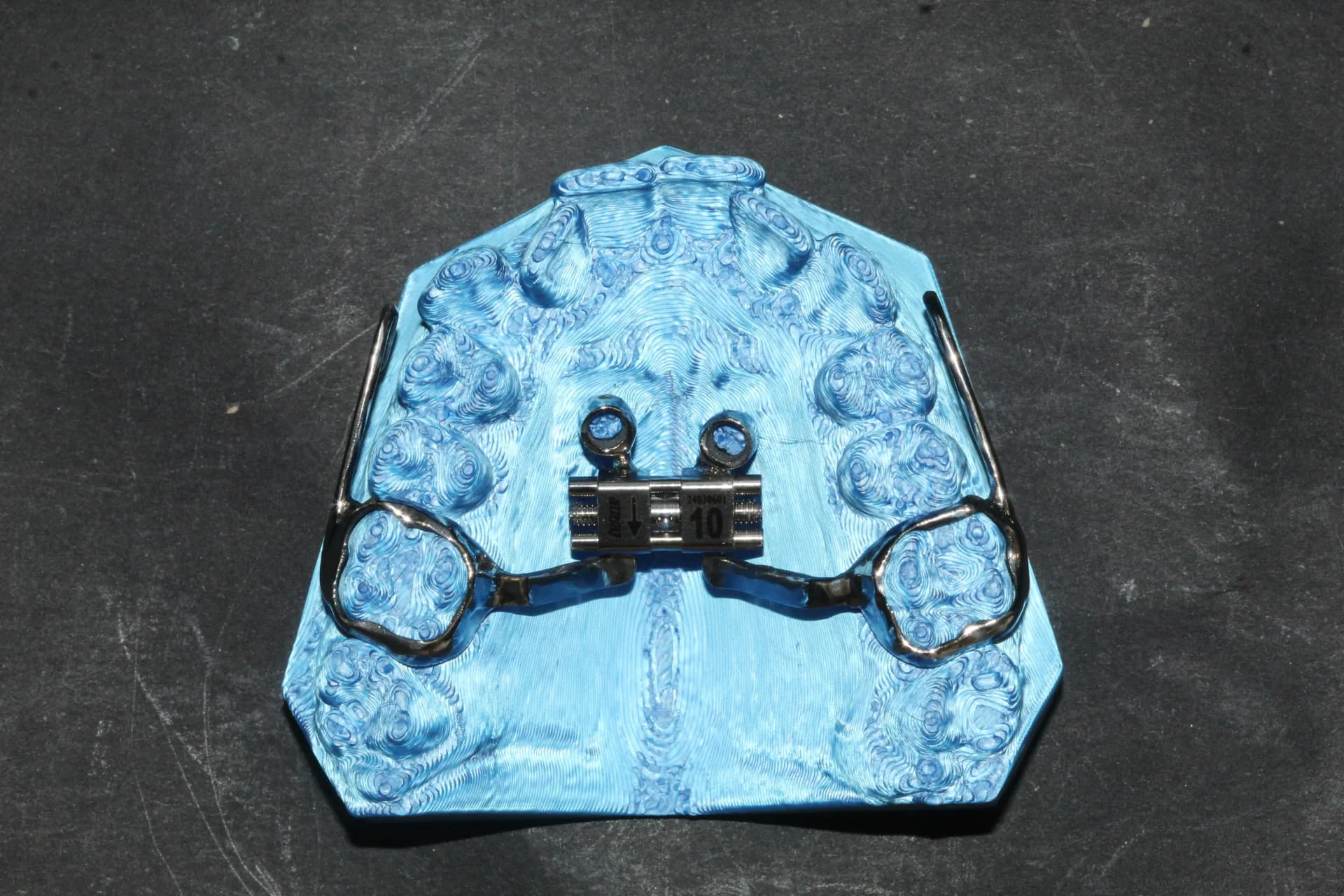 Hybrid Hyrax fogszabályozó készülék kék nyomatmodellen az Orim Dental laborjában